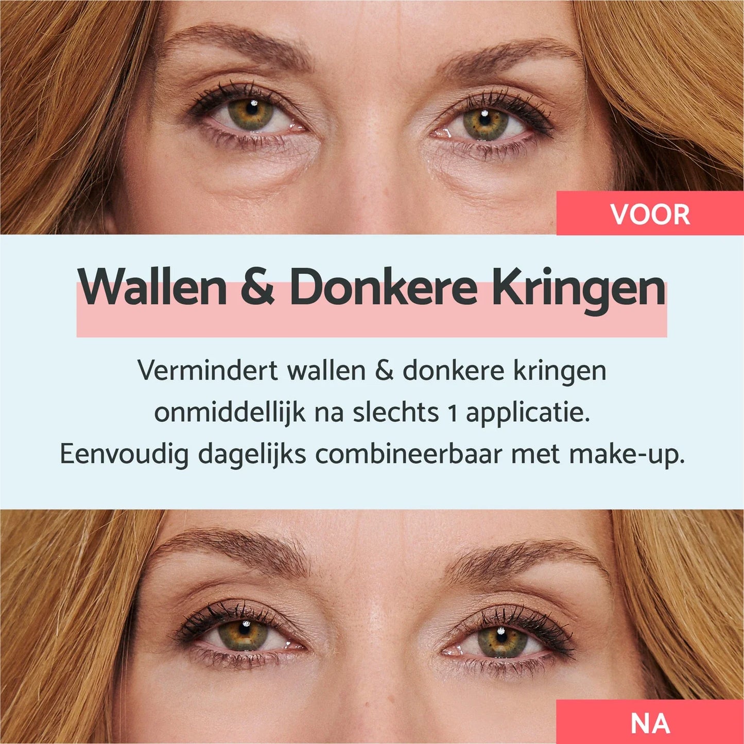 Eye Bags & Dark Circles